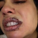 💔 Lo que parecía un retoque terminó en años de dolor: la historia que alerta a miles